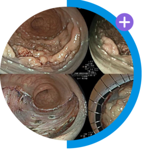 2. RESECCIÓN ENDOSCÓPICA AVANZADA - EMR / ESD